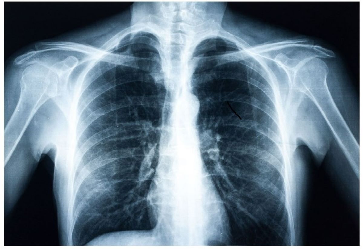 New AI Model Uses X-Rays to Predict Diabetes Risk